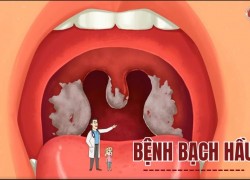 Bệnh bạch hầu là gì? Phương pháp điều trị an toàn, hiệu quả